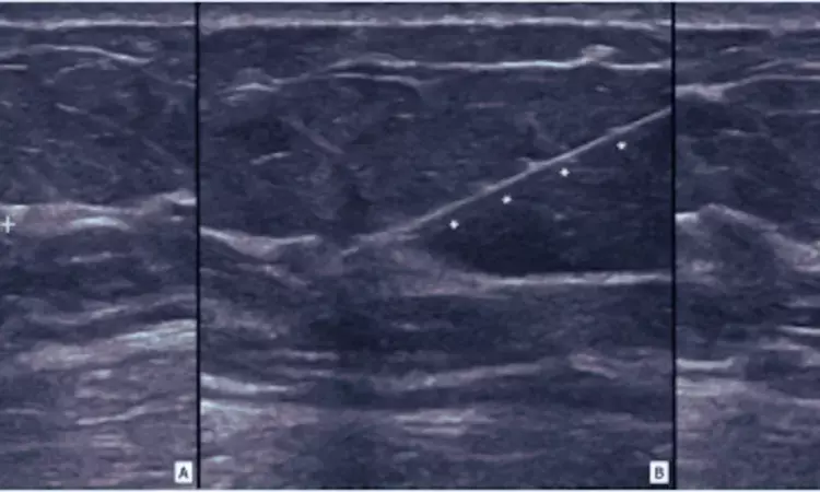 Ultrasound-guided localization with magnetic seeds effective for localizing small non-palpable breast lesions