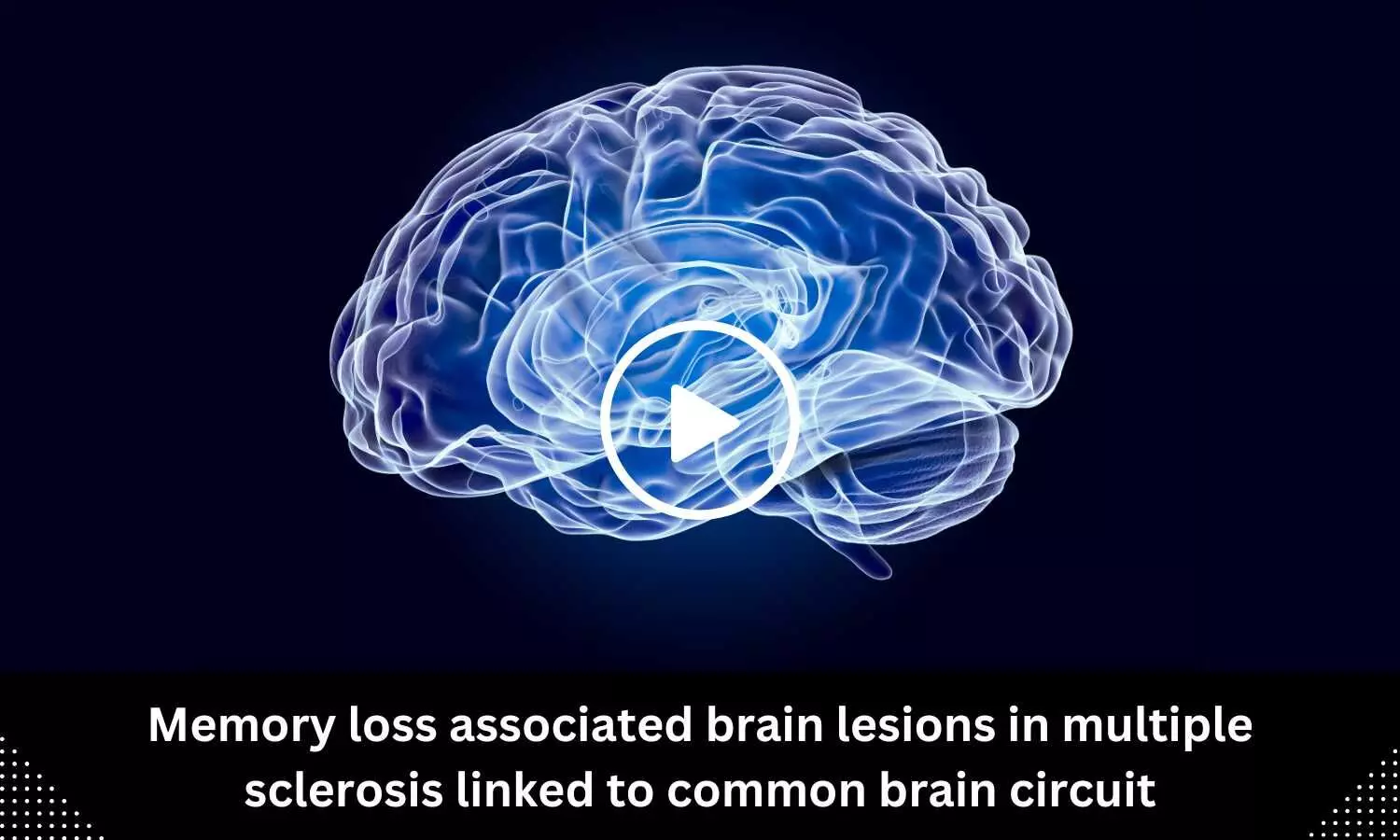 Memory loss-associated brain lesions in multiple sclerosis linked to common brain circuit