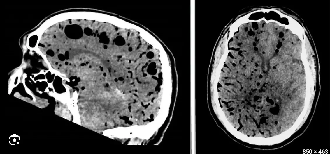 Unusual Case of Spontaneous Cerebral Air Embolism- A report