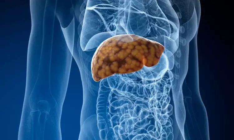 Severe Non-alcoholic fatty liver disease linked to hypertension