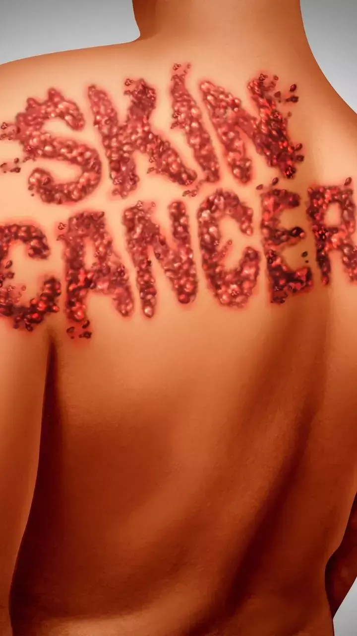 10 Strategies For Preventing Skin Cancer