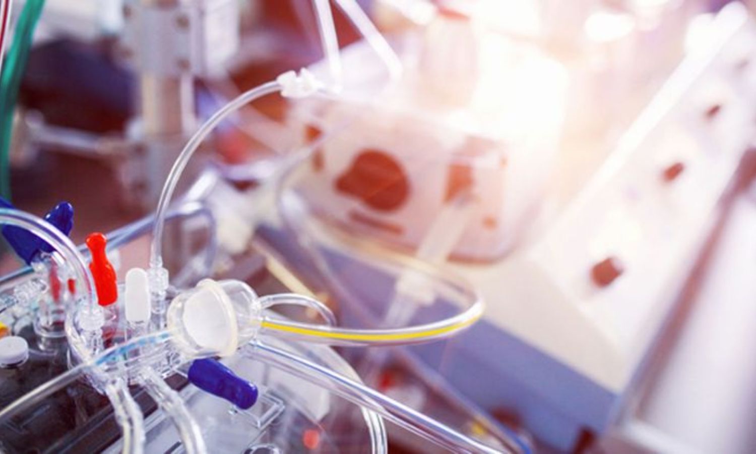 Microaxial flow pump fails to improve outcomes for high-risk heart attack patients without cardiogenic shock: Study