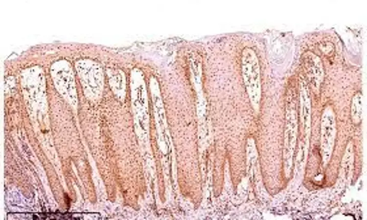 Endothelin 1 may emerge as new Urine Marker of Metabolic Complications in Psoriasis