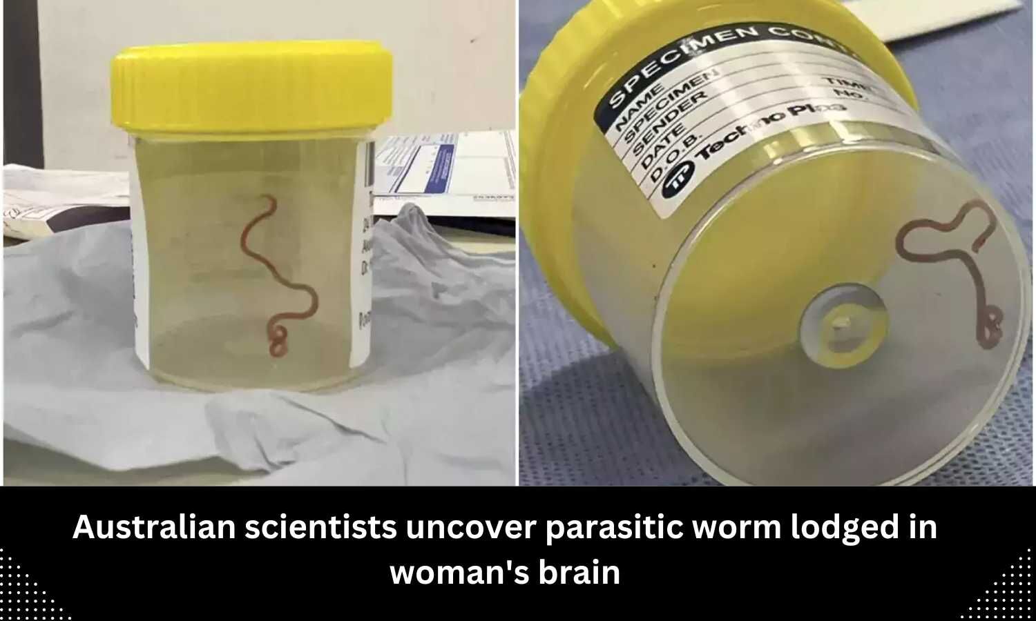 Australian scientists uncover parasitic worm lodged in woman's brain