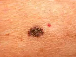 Gut dysbiosis linked to genesis and progression of melanoma