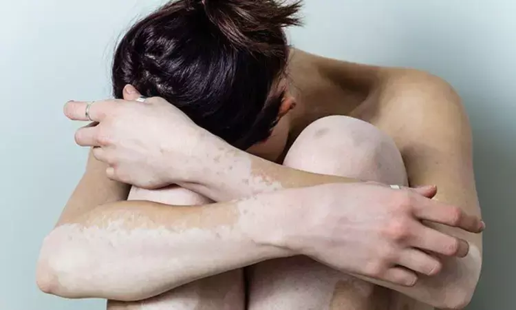 Fire needle therapy improves repigmentation in non-segmental stable vitiligo: Study
