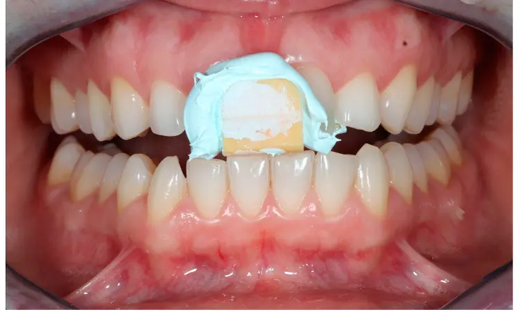 Occlusal devices fabricated using fully digital workflow have better occlusal adjustment versus those fabricated using an analog workflow
