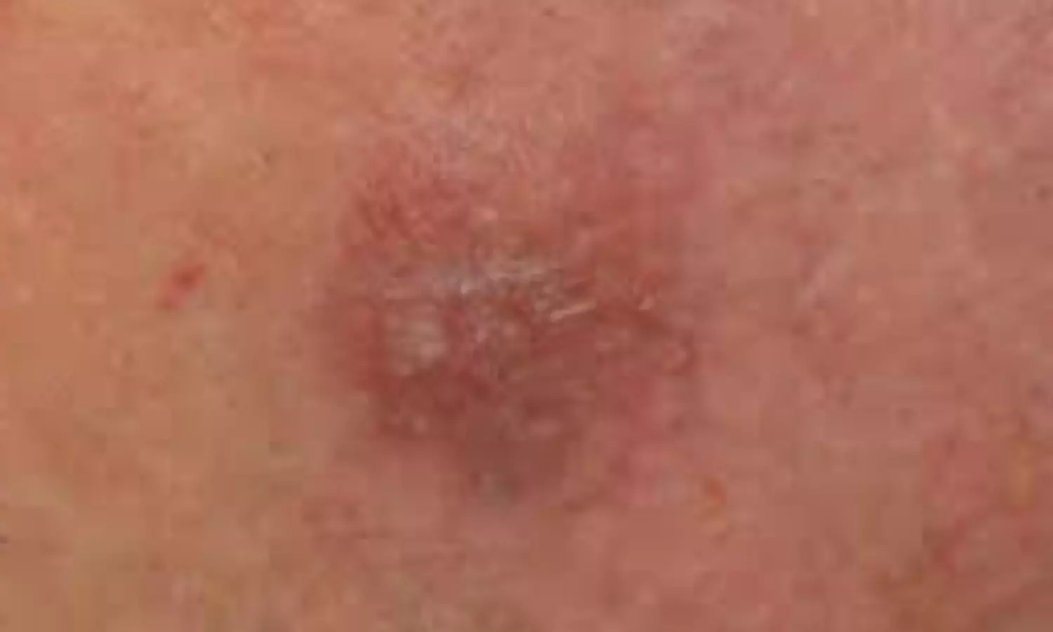 Minocycline Shows Promising for Treating Rare Skin Condition Granuloma Faciale: Case report