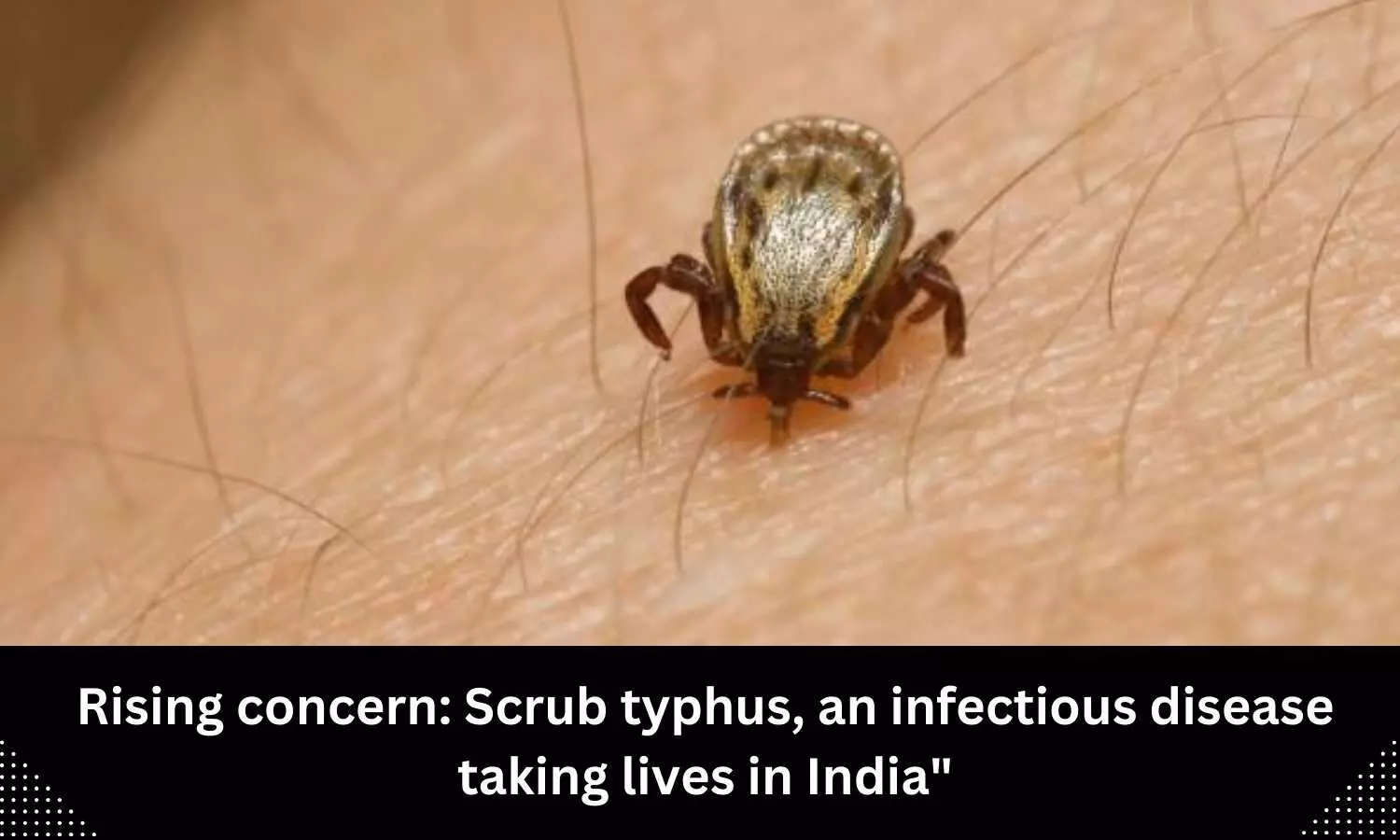 Rising concern: Scrub typhus, an infectious disease taking lives in India