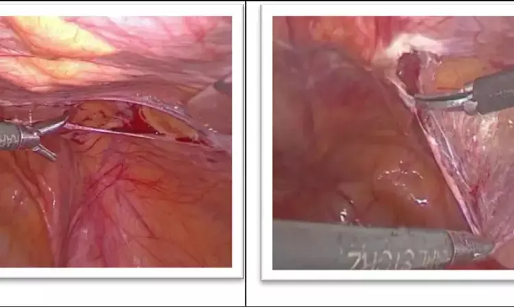 Laparoscopic TEP surgical  approach as effective as laparoscopic TAPP for bilateral inguinal hernia repair