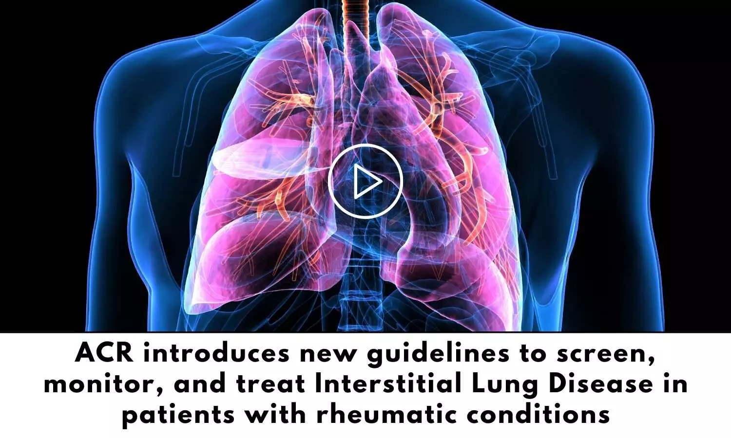 ACR New Guidelines for Interstitial Lung Disease management