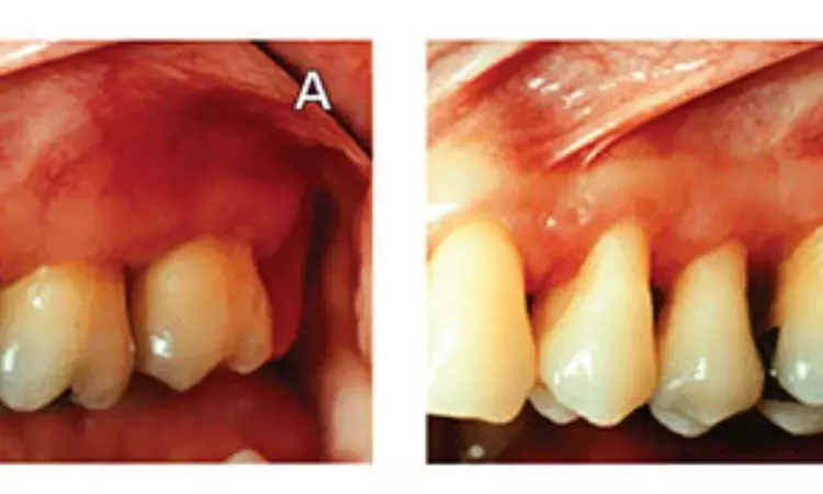 Calcium sodium phosphosilicate and arginine dentifrices reduce root sensitivity after nonsurgical periodontal therapy