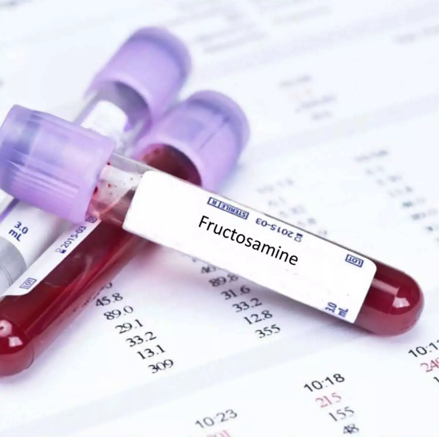 Fructosamine not a reliable Test for Detection of Hyperglycemia