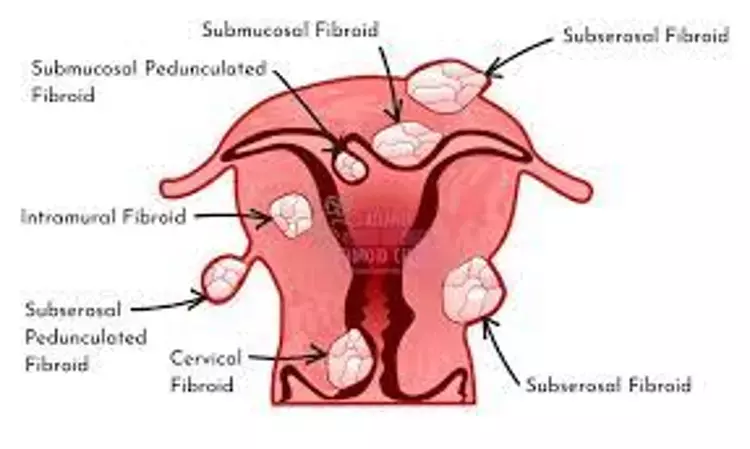 Fibroid size and location may increase likelihood of PPH