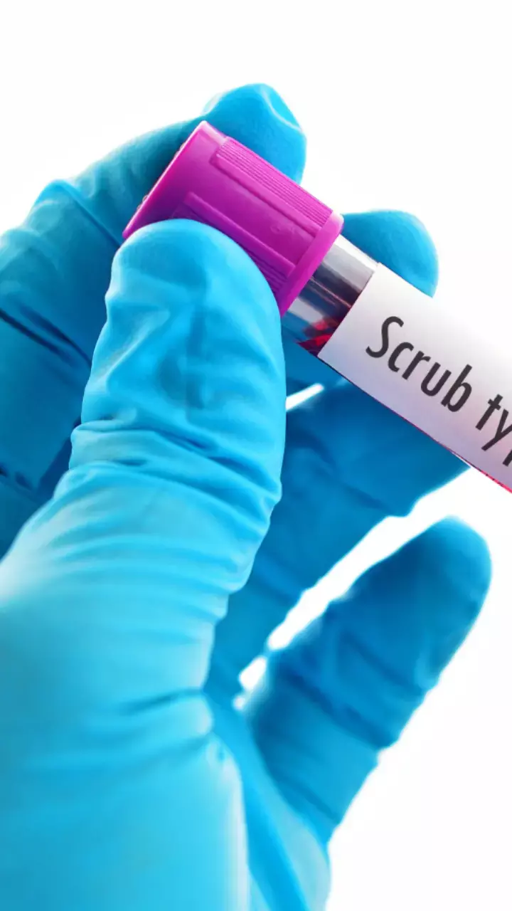 Odisha Affected By Scrub Typhus: Know All About It