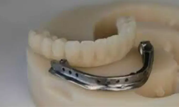 CAD/CAM-milled monolithic zirconia structures combined with titanium bar infrastructures promising option for full-arch implant restorations