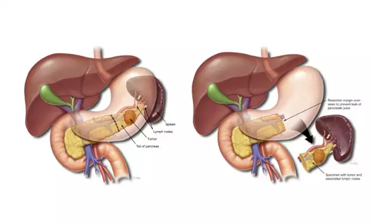 Laparoscopic distal pancreatectomy useful and safer technique for tumors of pancreatic neck