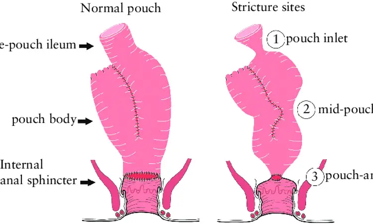 Salvage surgery effective treatment alternative for J-pouch afferent limb stricture