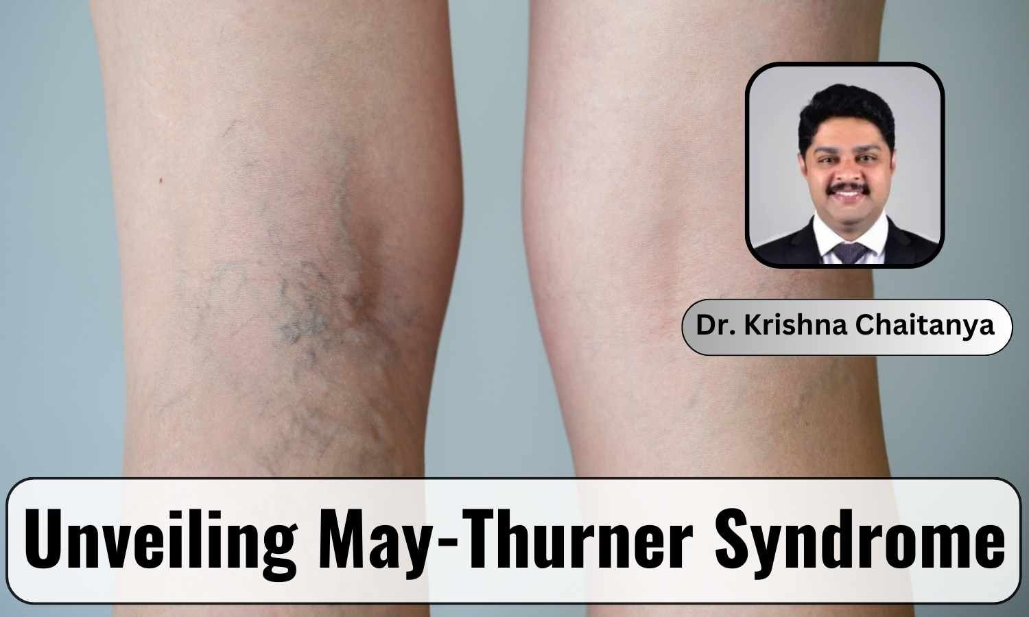 Unveiling May-Thurner Syndrome: A Hidden Vascular Condition - Dr ...