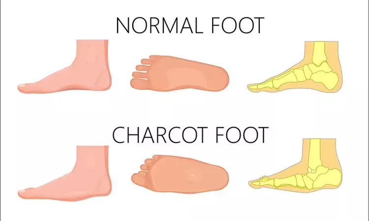 Muscle atrophy and muscle edema significantly more severe in diabetic patients with Charcot foot disease