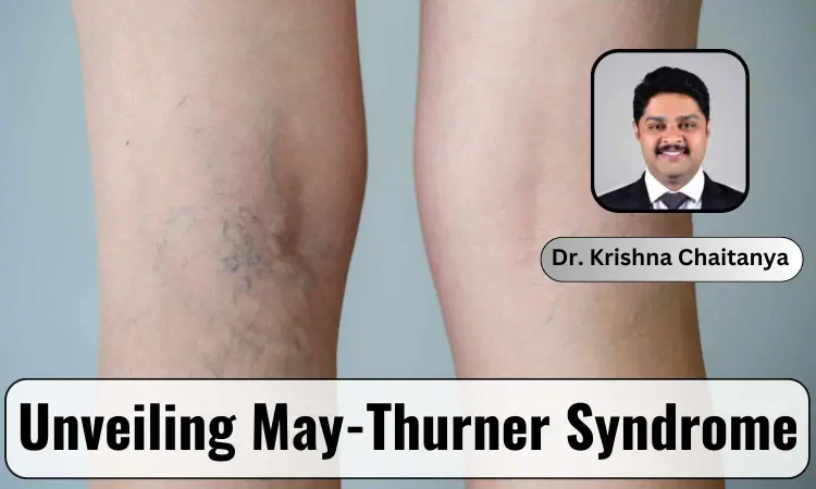 Unveiling May-Thurner Syndrome: A Hidden Vascular Condition - Dr Krishna Chaitanya