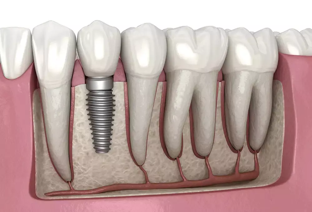 Presence of One or Two Adjacent Teeth may not impact Marginal Bone Level Changes Around Dental Implants