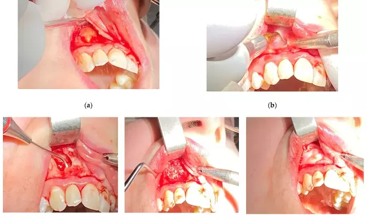 Endodontic Microsurgery Using cone-beam computed tomography  Leads to Predictable Healing in Teeth Without Periodontal Involvement
