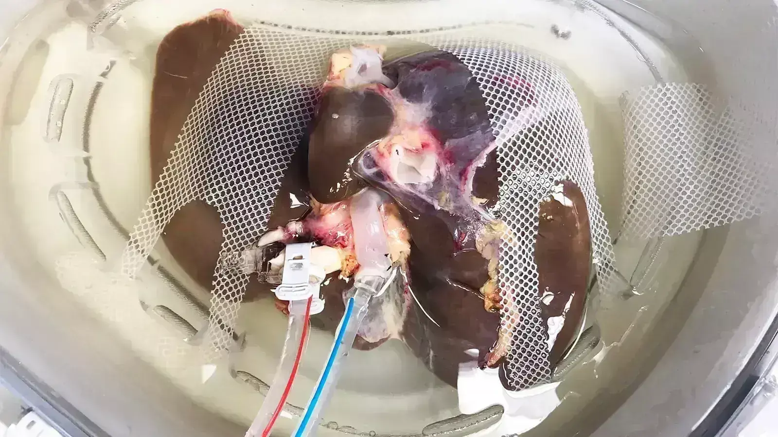Dynamic organ perfusion techniques tied to less organ rejection after liver transplantation compared to static cold storage