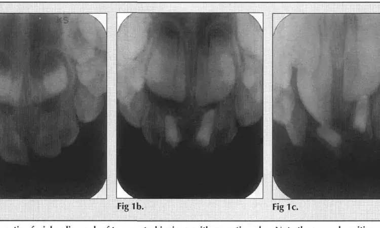 Pulpectomy treatment of choice for necrotic primary molars compared to extraction