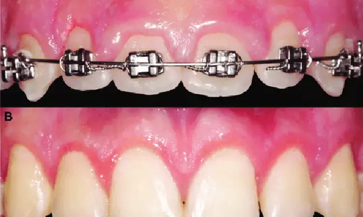 Diode laser gingivectomy for orthodontic treatment-induced gingival hyperplasia bests scalpel surgery