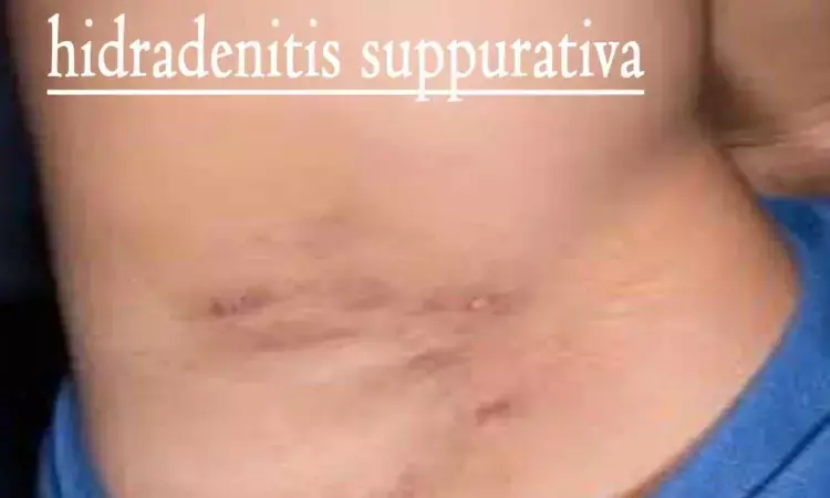 Bariatric surgery significantly lowers risk of severe hidradenitis suppurativa in obese individuals