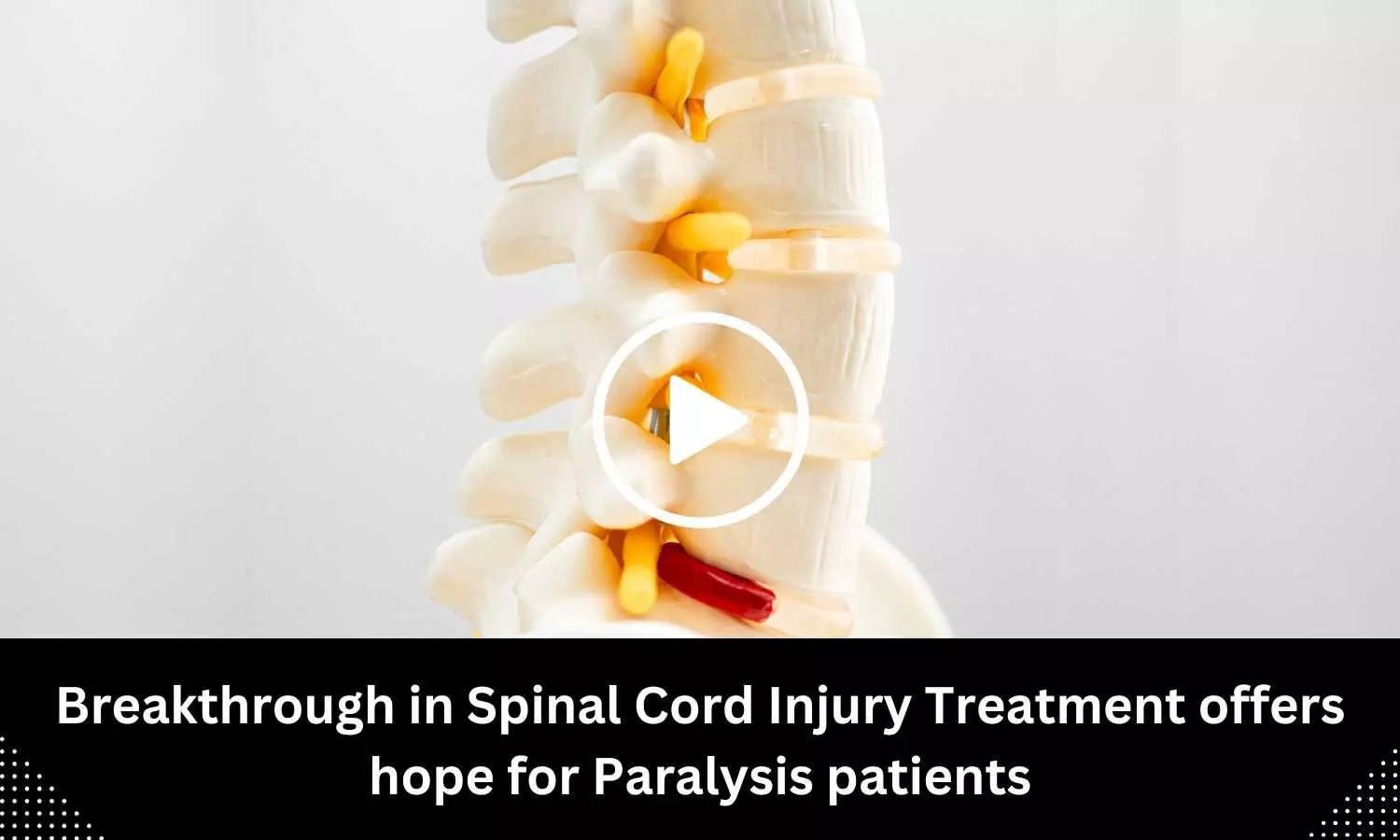 Breakthrough in Spinal Cord Injury Treatment offers hope for Paralysis patients
