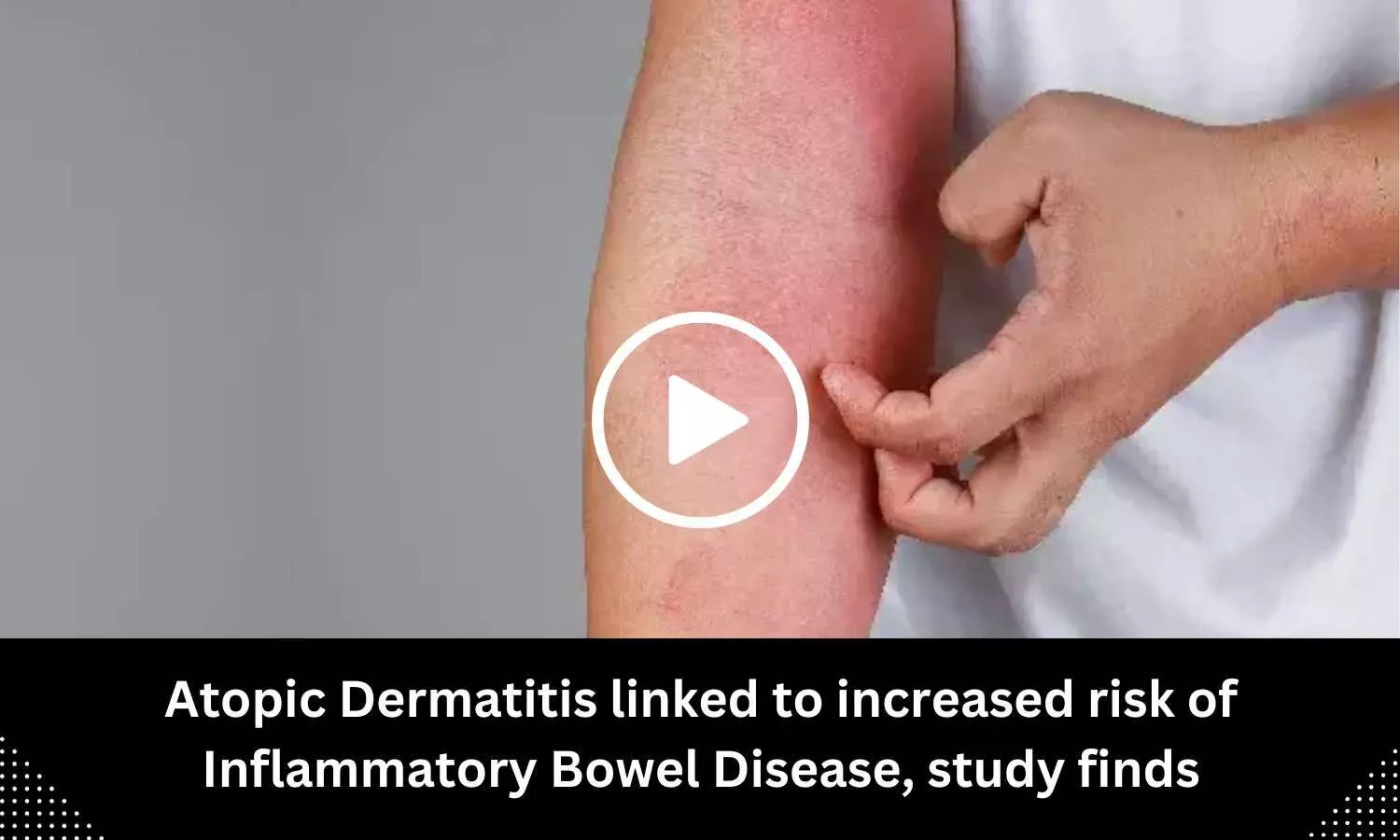 Atopic Dermatitis linked to increased risk of Inflammatory Bowel Disease, study finds