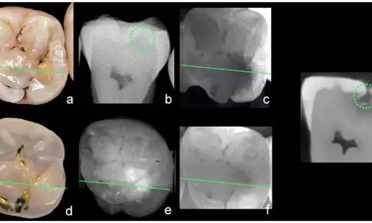 Intraoral scanners incorporating near-infrared imaging promising real-time  diagnostic tool for caries