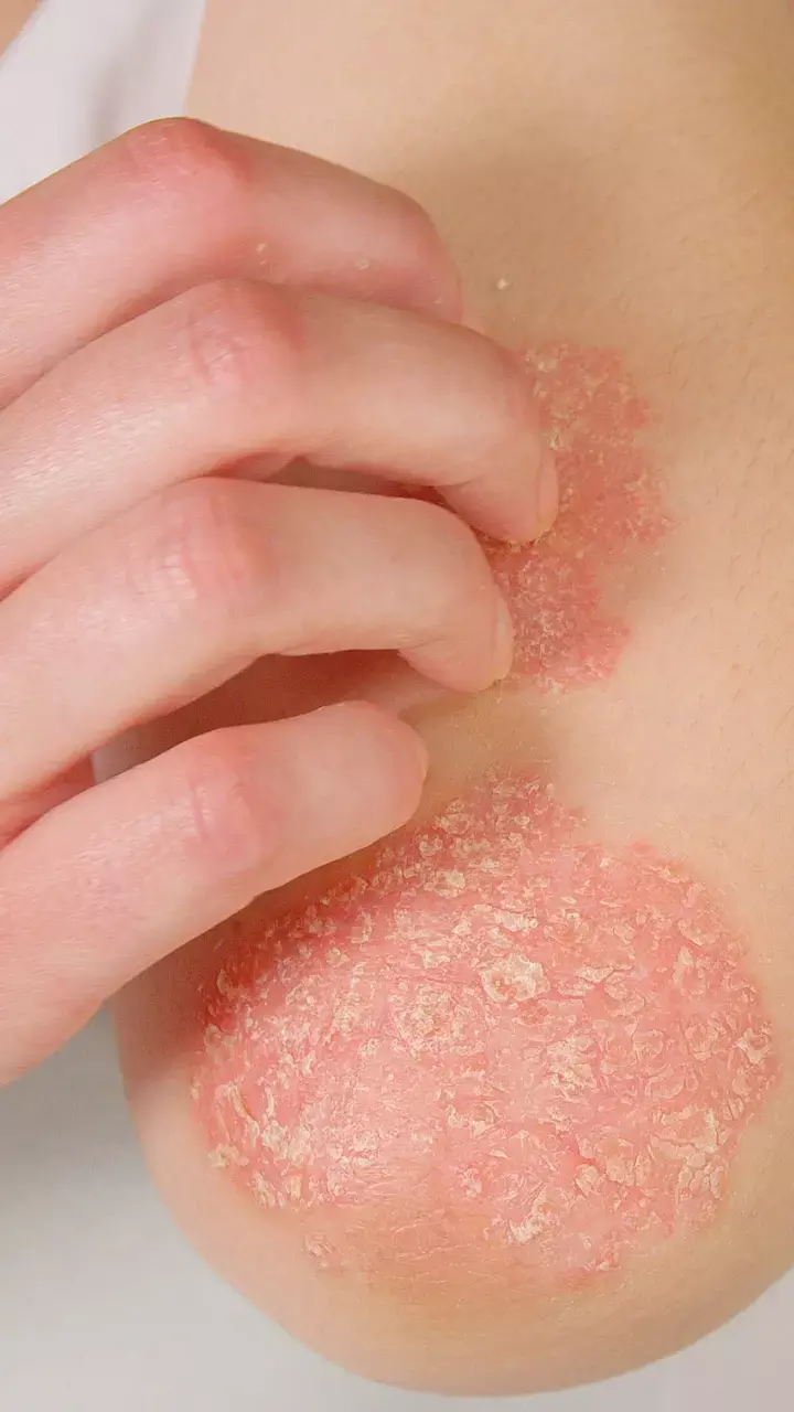 Know How Severe Psoriasis Is Linked With Increased Risk Of Heart Disease