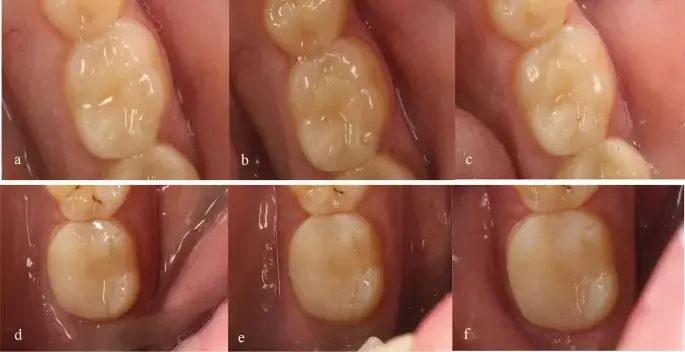 Polymer-infiltrated and lithium disilicate ceramic crowns have similar survival rates and clinical performance in oral rehabilitation