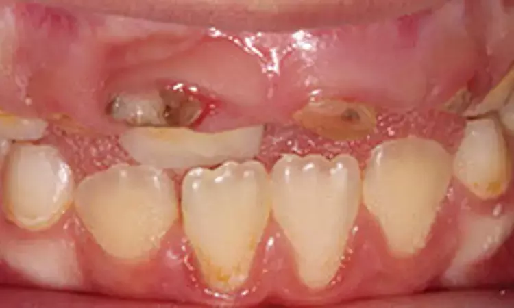 Silver diamine fluoride-modified atraumatic restorative technique effective treatment option for caries control in primary molars