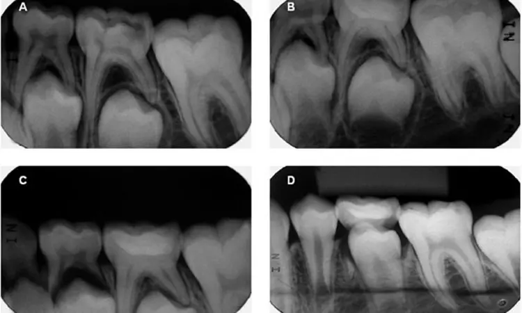 MTA or CEM useful pulp capping option for diode laser pulpotomy in primary molars