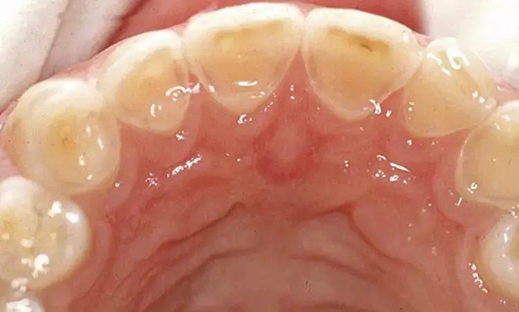 Occlusal veneer restorations may help relieve thermal and biting sensitivity in cracked teeth