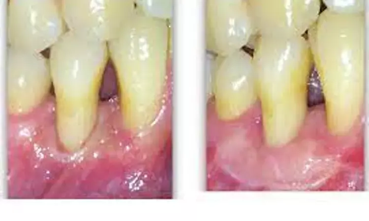 Augmentation of Keratinized tissue  height doesnt impact clinical outcomes in patients with  short dental implants