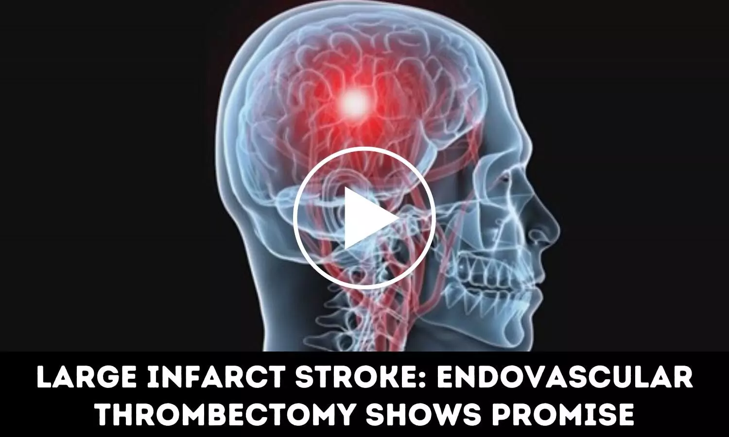 Large Infarct Stroke: Endovascular Thrombectomy Shows Promise