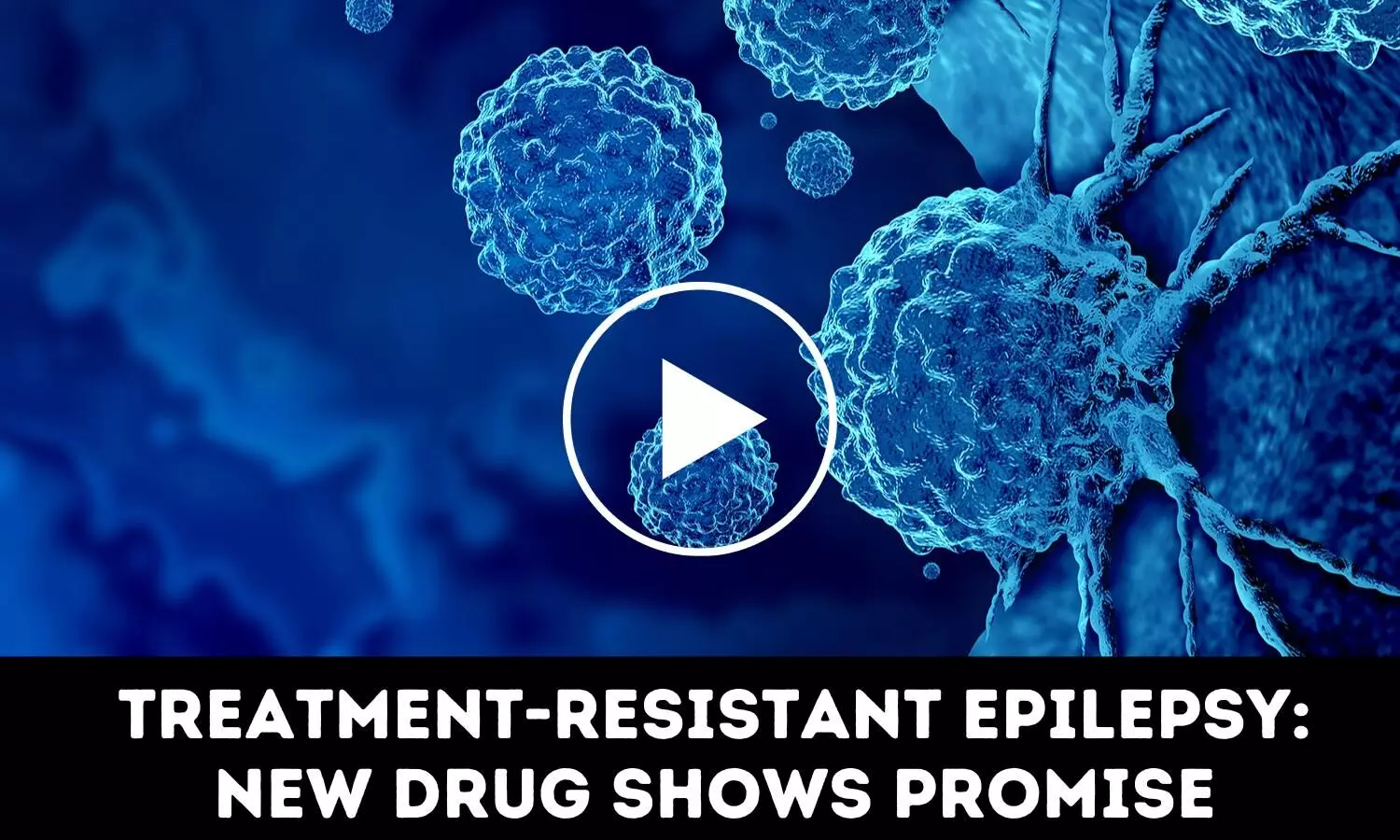 Treatment resistant epilepsy : New drug shows promise