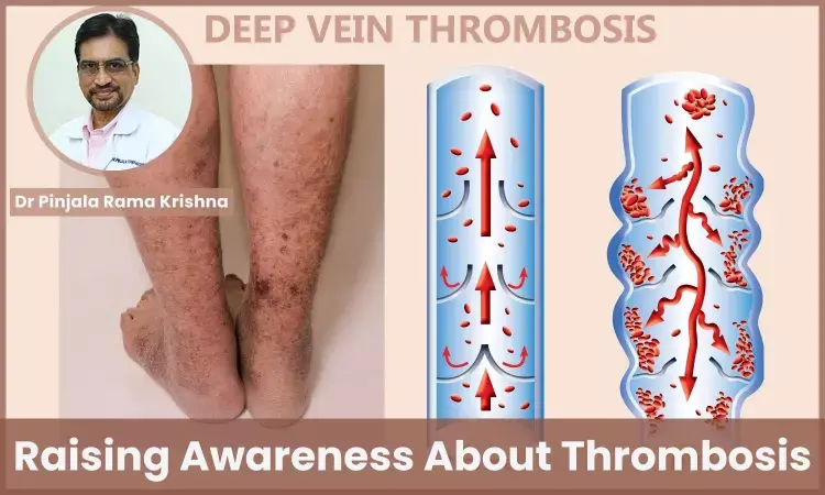 World Thrombosis Day: Raising Awareness and How to Prevent Blood Clots? - Dr Pinjala Rama Krishna