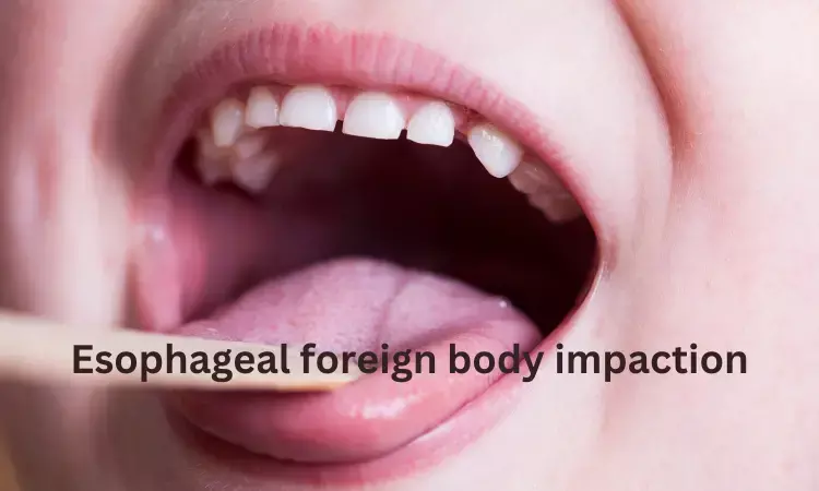 Glucagon no better than placebo for resolving esophageal foreign body