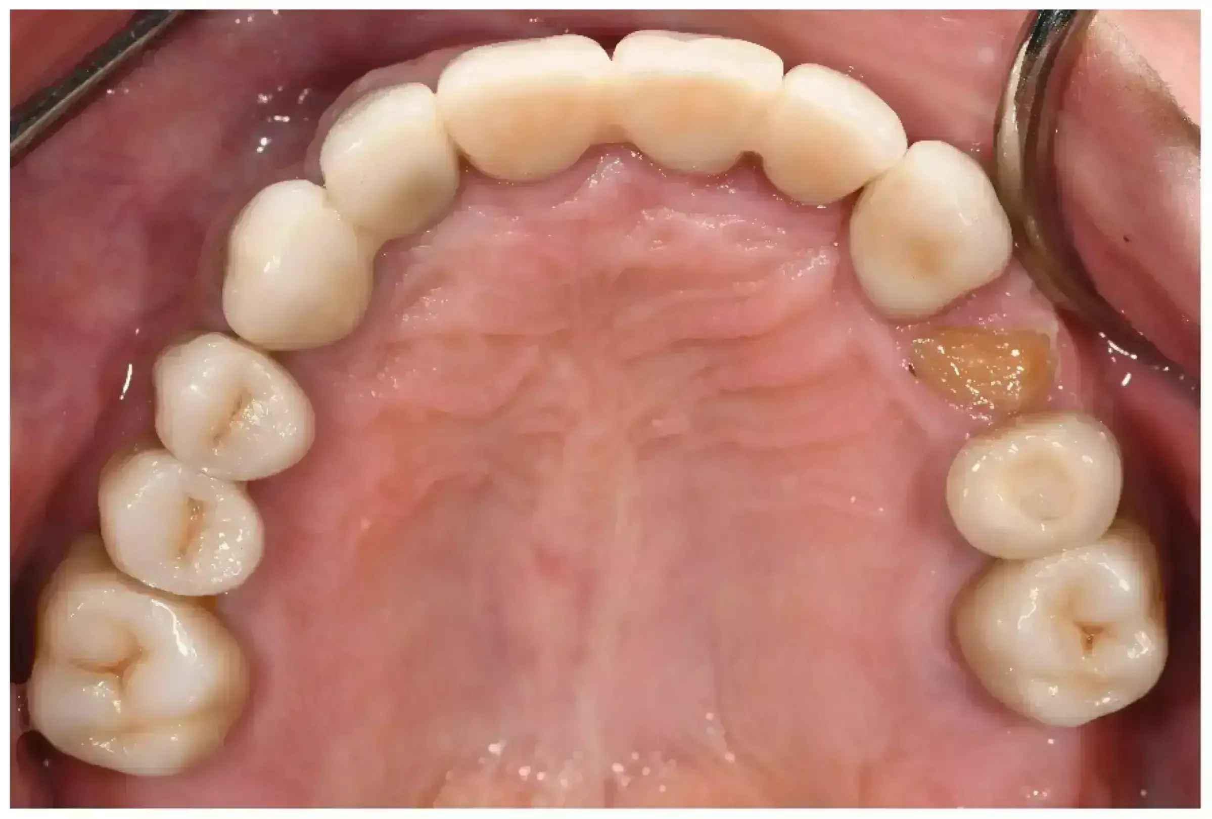 Monolithic zirconia crowns cemented with two different self-adhesive resins survive long with no risk of veneer chipping