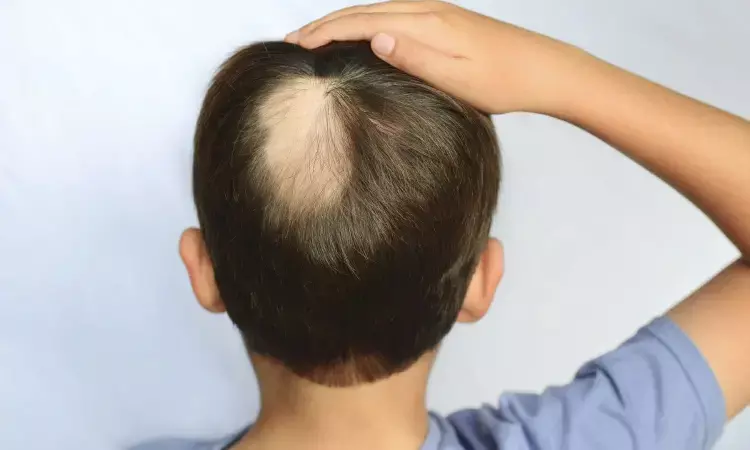 Oral tofacitinib, novel alternative treatment for resistant alopecia areata among children