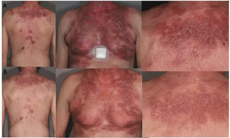 Treatment of atopic dermatitis with dupilumab associated with reversible and benign Lymphoid reaction