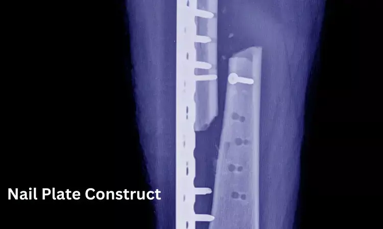 Nail Plate Construct shows effective fixation and immediate weightbearing post-operatively