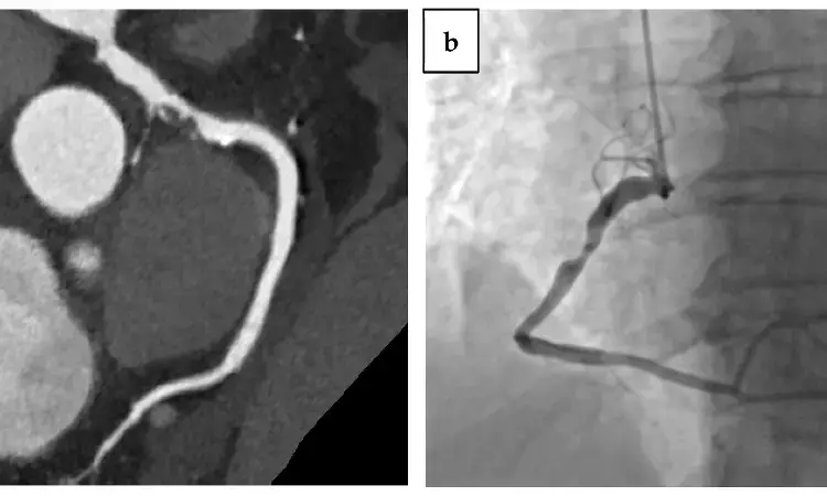 Coronary artery calcium evaluation with chest CT strongly linked to severity of coronary disease and mortality