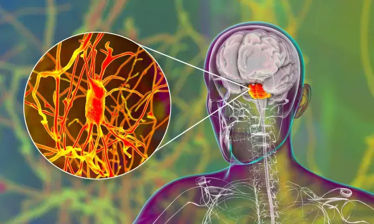 Case report shows promising results using transcranial magnetic stimulation for post-stroke ataxia